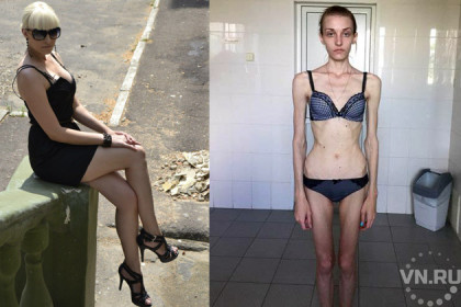 Девушка опять теряет вес: состояние ужасно