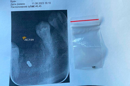 Кусок инструмента на месте вырванного зуба оставил стоматолог у пациентки в Новосибирске