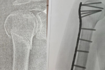 Жительница Новосибирска требует компенсацию с магазина за тяжелый перелом