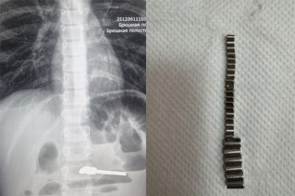 25 инородных тел достали из мальчика в Новосибирске