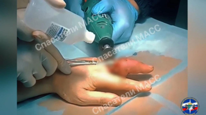 Спасатели и хирурги снимали кольцо с пальца мужчины в Новосибирске