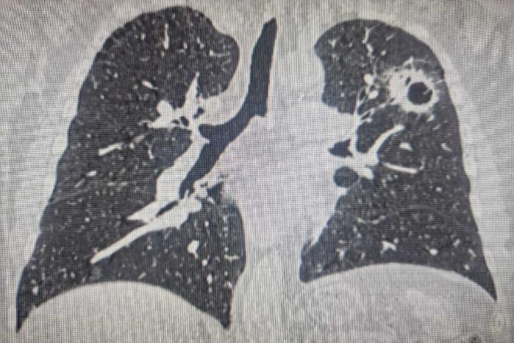 Житель Новосибирска выжил после трех случаев рака и двух операций