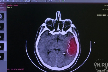 Инсульт с помощью нейросети диагностируют новосибирские медики