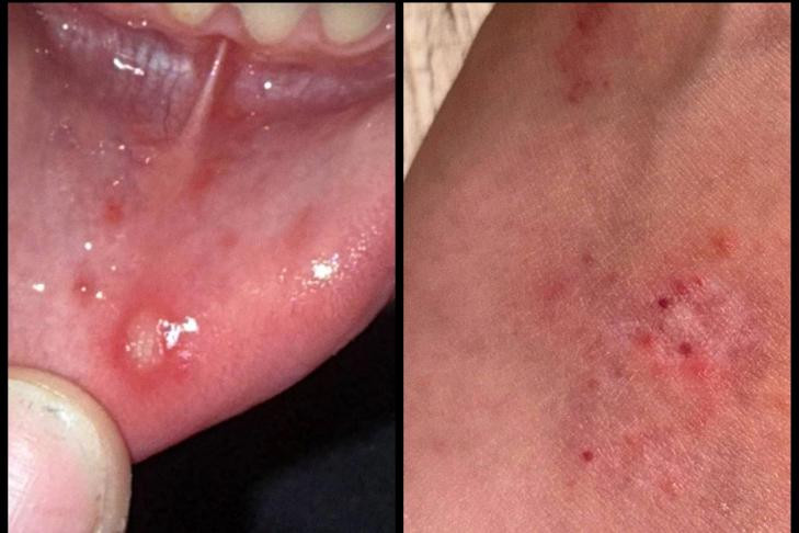 Сибирячка показала первый симптом вируса Коксаки у дочери