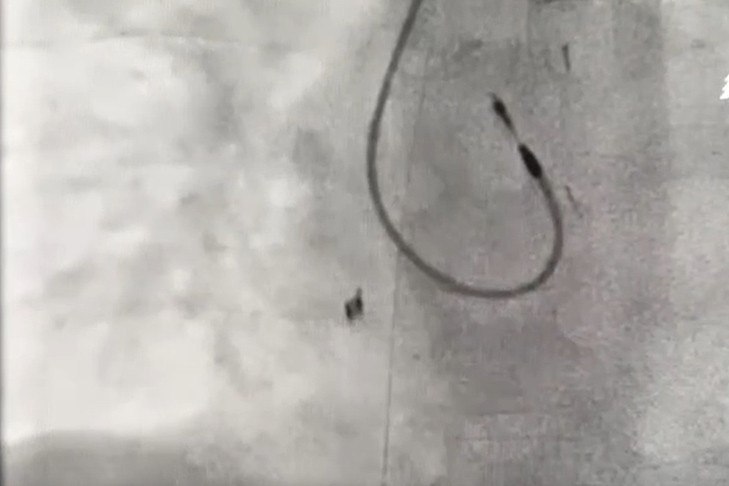 Полутораметровую струну оставили в теле ребенка врачи Новосибирска